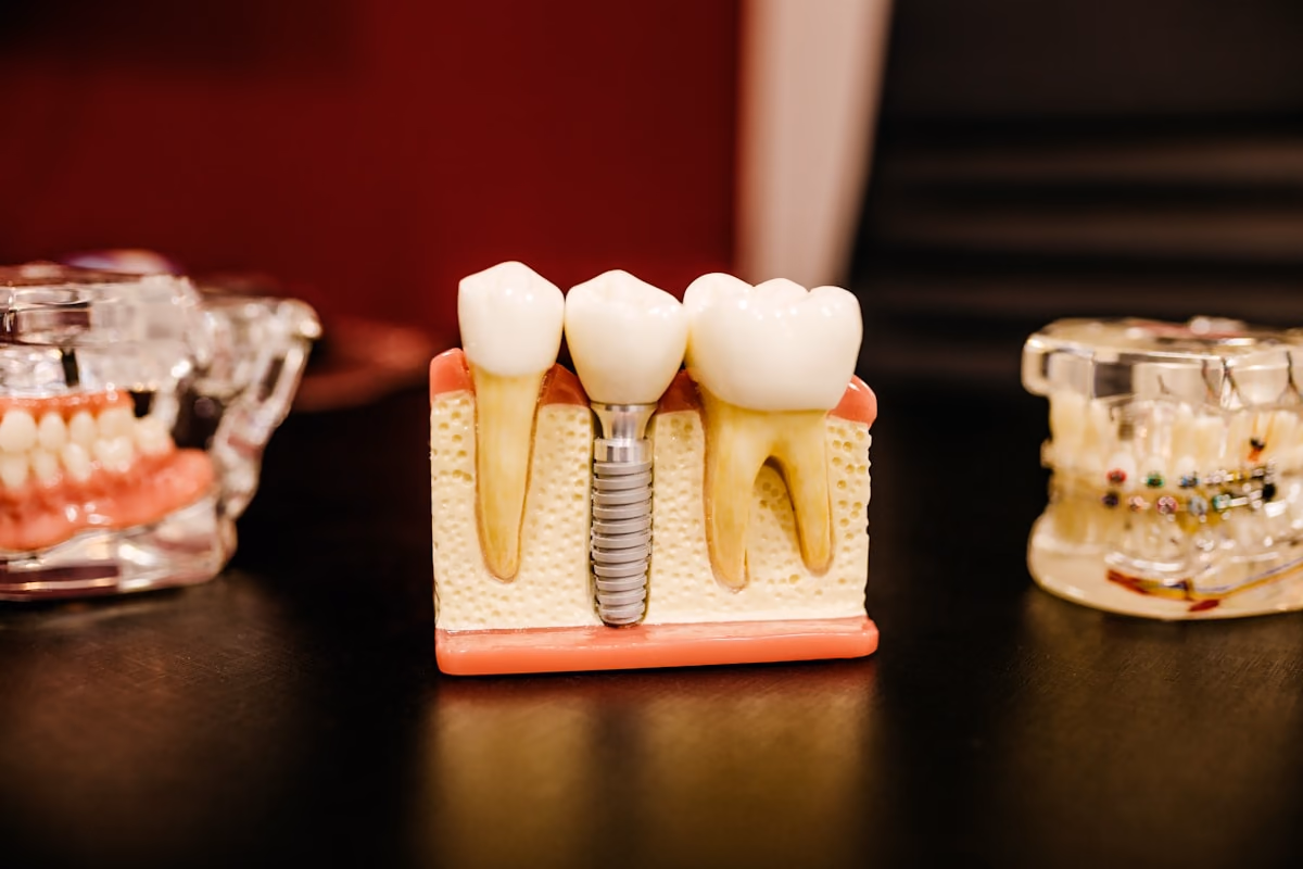 Implante dentário